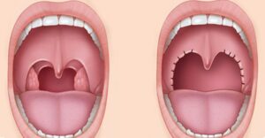 Ilustrație comparativă înainte și după amigdalectomie – îndepărtarea chirurgicală a amigdalelor palatine.