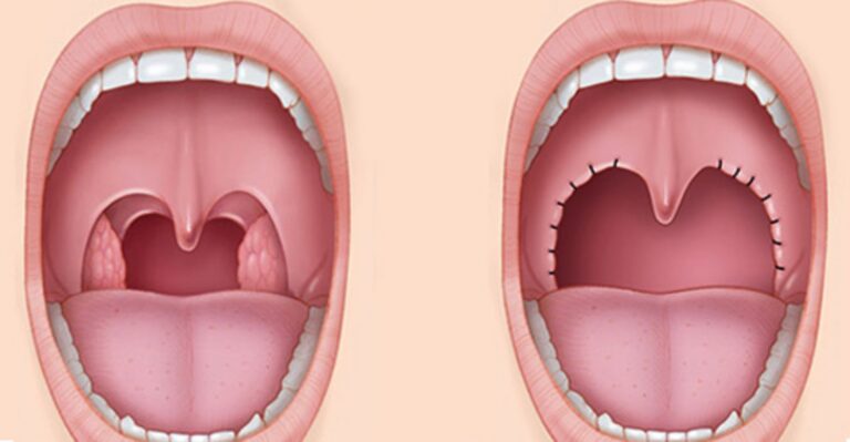 Ilustrație comparativă înainte și după amigdalectomie – îndepărtarea chirurgicală a amigdalelor palatine.