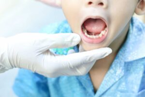 Examinare orală la copil pentru diagnosticarea frenului lingual scurt înainte de frenotomie.