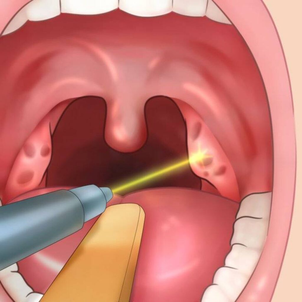 Ilustrație medicală a unei criptolize amigdaliane cu laser – tratament minim invaziv pentru amigdalita cronică criptică.