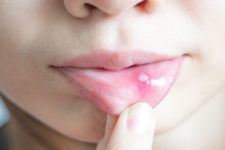 Aftă dureroasă pe interiorul buzei inferioare, simptom frecvent al stomatitei aftoase.